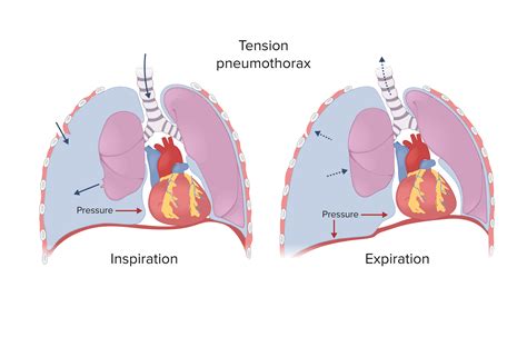 tension pneumothorax chest trauma